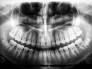 What Does Dreaming of Teeth Falling Out Mean?